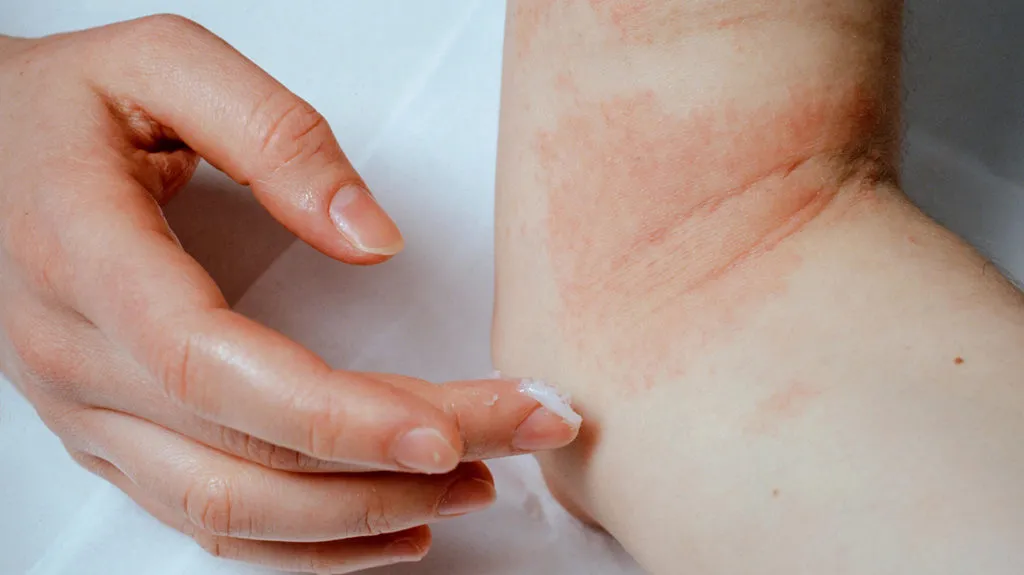 applying cream on eczema rash